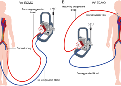 Extracorporeal Membrane Oxygenation Machine Market