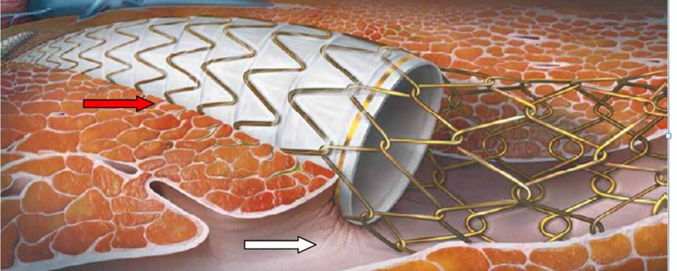 Gastrointestinal Stent Market