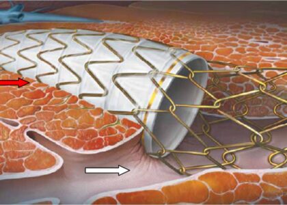 Gastrointestinal Stent Market