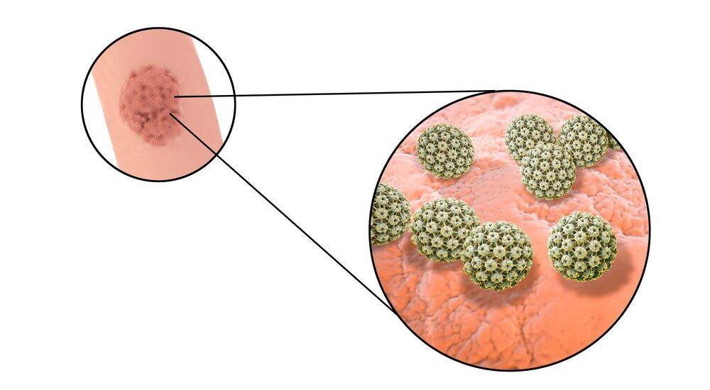 Genital Warts (Condyloma Acuminatum) Market