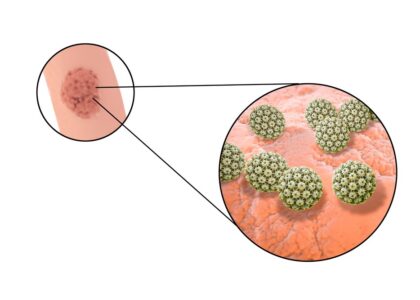 Genital Warts (Condyloma Acuminatum) Market