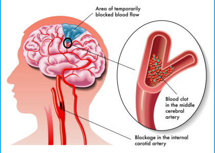 Ischemic Stroke Aspiration Systems Market