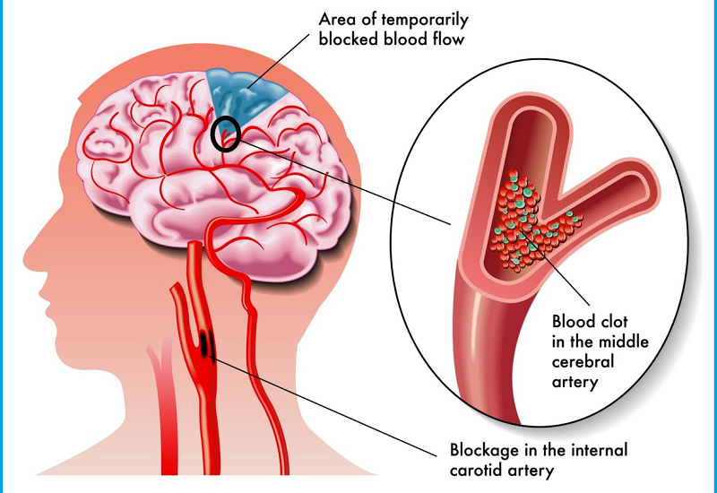 Ischemic Stroke Aspiration Systems Market