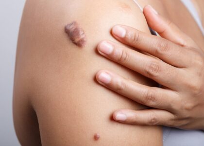 Keloid Treatment Market