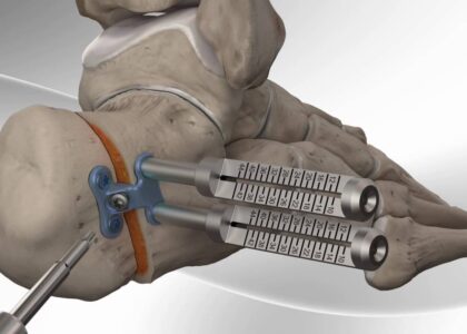 Osteotomy Plates Market