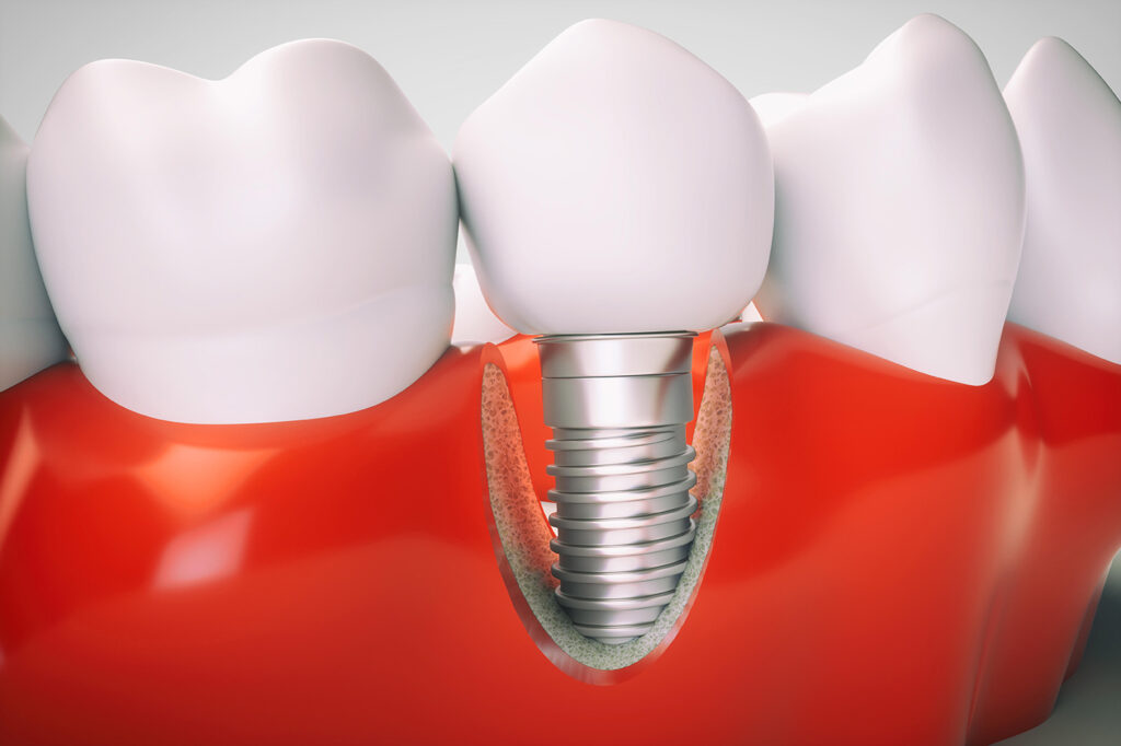 Peri-Implantitis Treatment Market