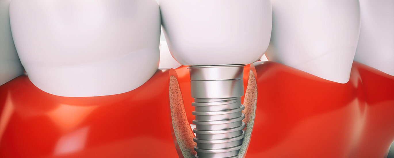 Peri-Implantitis Treatment Market