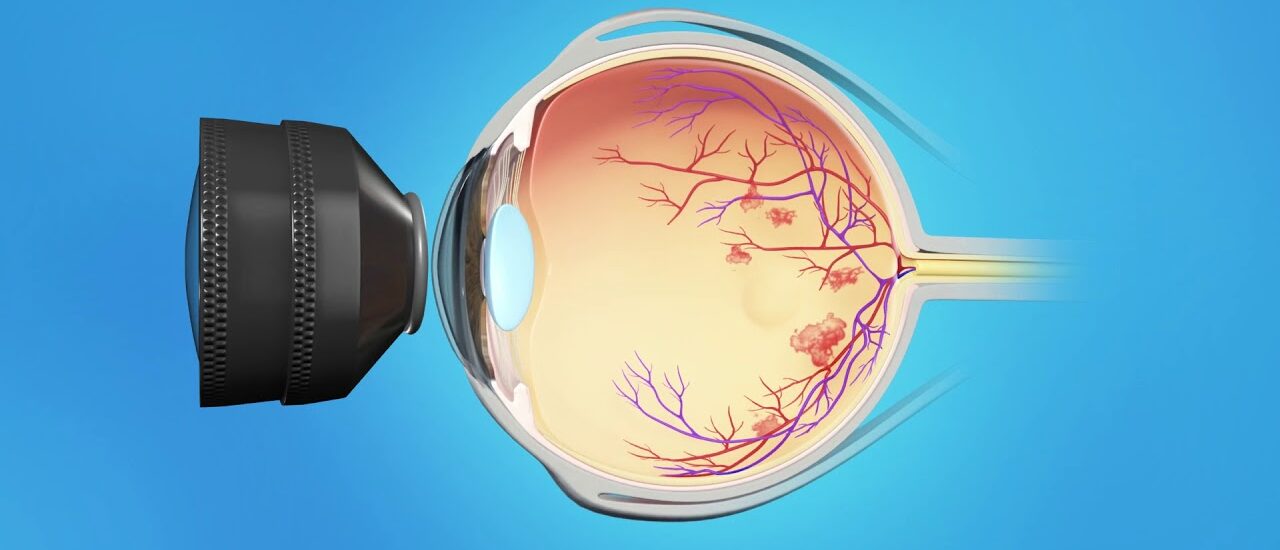 Retinal Vein Occlusion Treatment Market