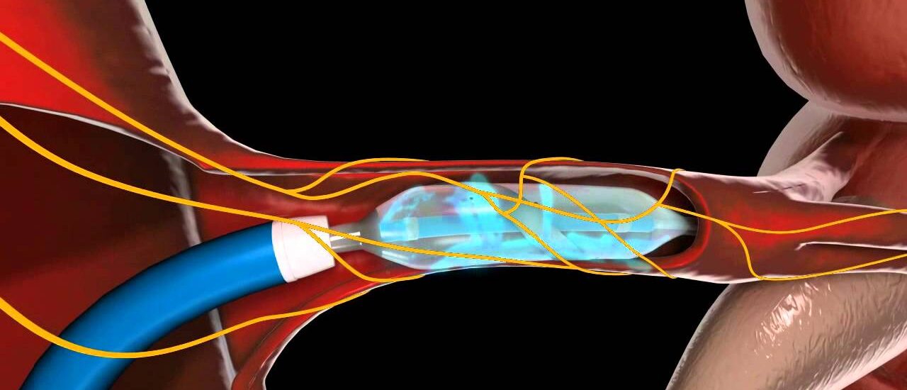 Sonohysterography Catheters Market