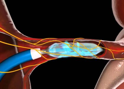 Sonohysterography Catheters Market