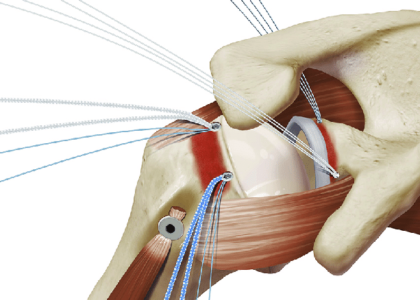 Suture Anchor Devices Market