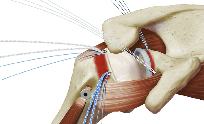 Suture Anchor Devices Market