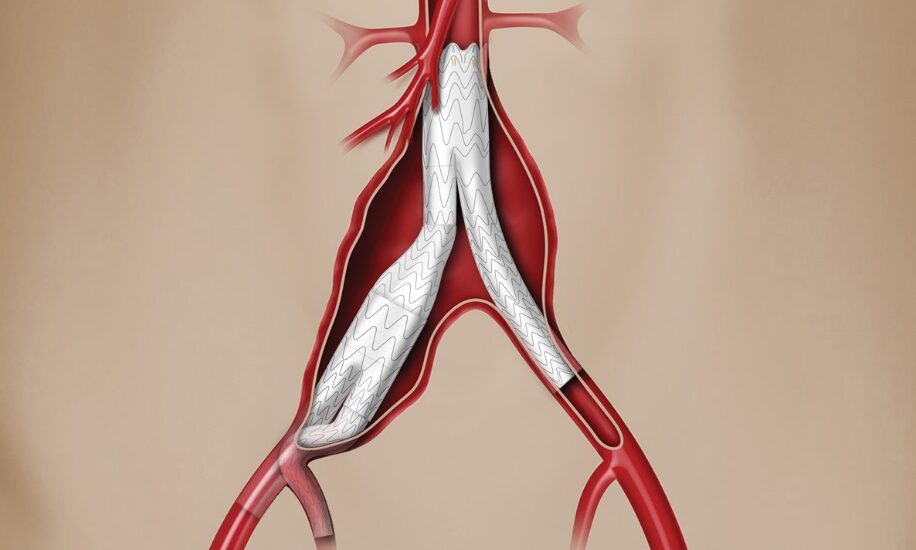 Thoracic Vascular Stent Grafts Market