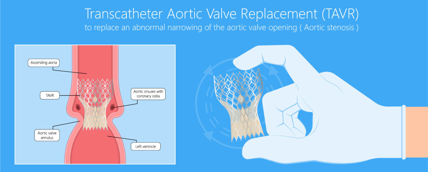 Transcatheter Heart Valve Replacement (TAVR) Market