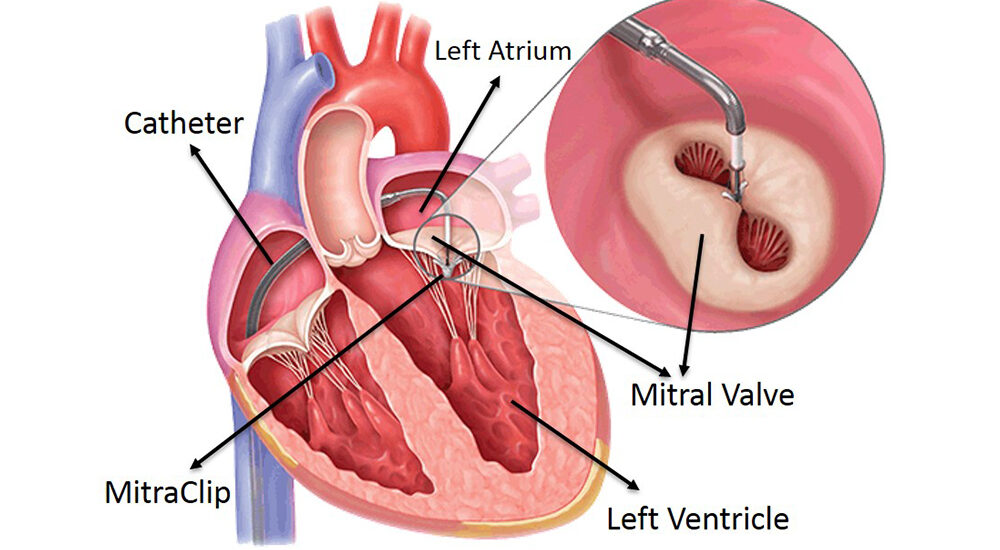 Transcatheter Mitral Valve Market