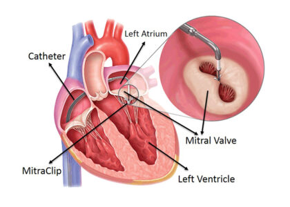 Transcatheter Mitral Valve Market