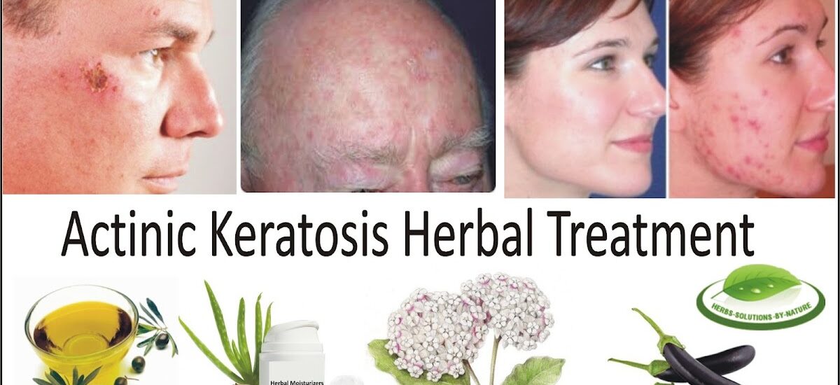 Actinic Keratosis Treatment Industry