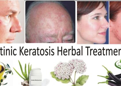 Actinic Keratosis Treatment Industry