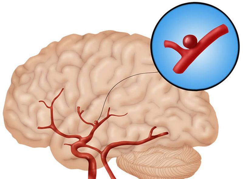 Cerebral Aneurysm Management Market