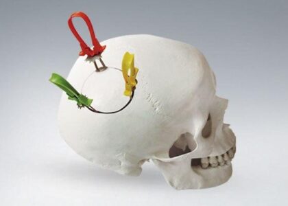 Cranial Stabilisation Devices Market