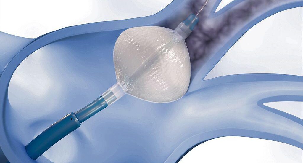 Cryoballoon Ablation System Market