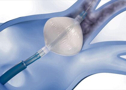 Cryoballoon Ablation System Market