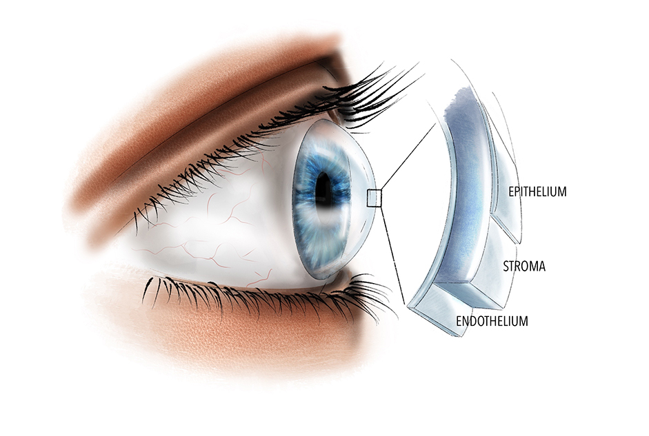 Fuchs Endothelial Corneal Dystrophy (FECD) Market