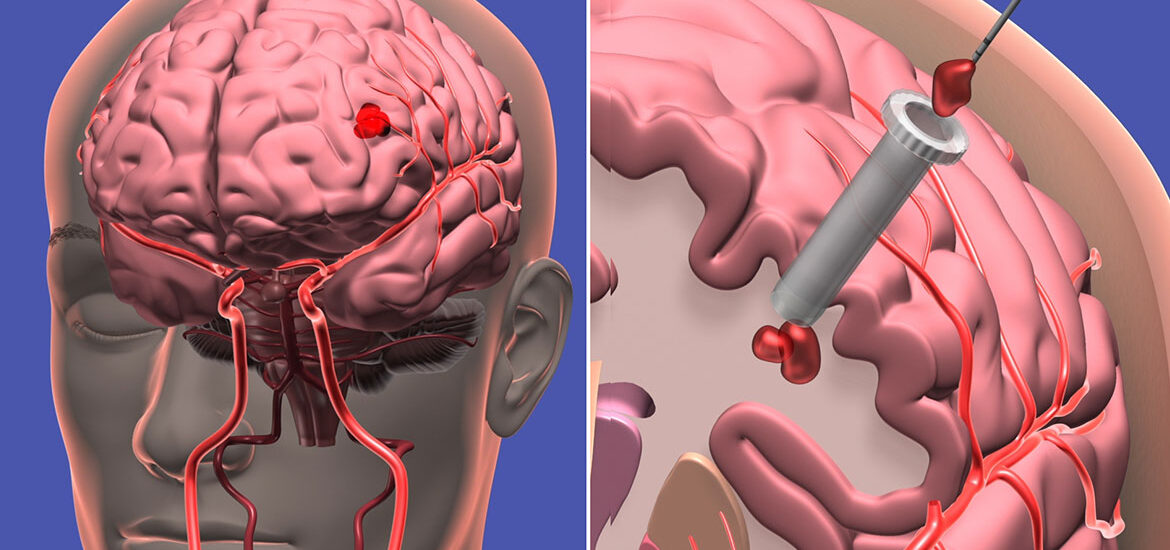 Intracranial Aneurysms Market