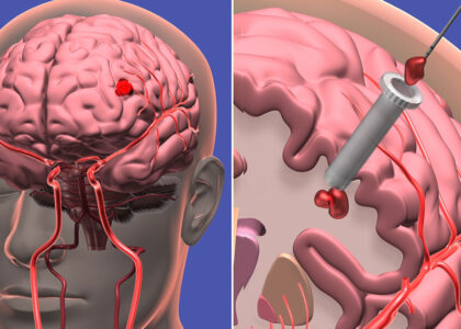 Intracranial Aneurysms Market