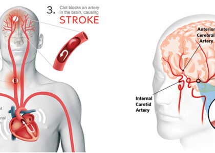 Ischemic Stroke Aspiration Systems Market