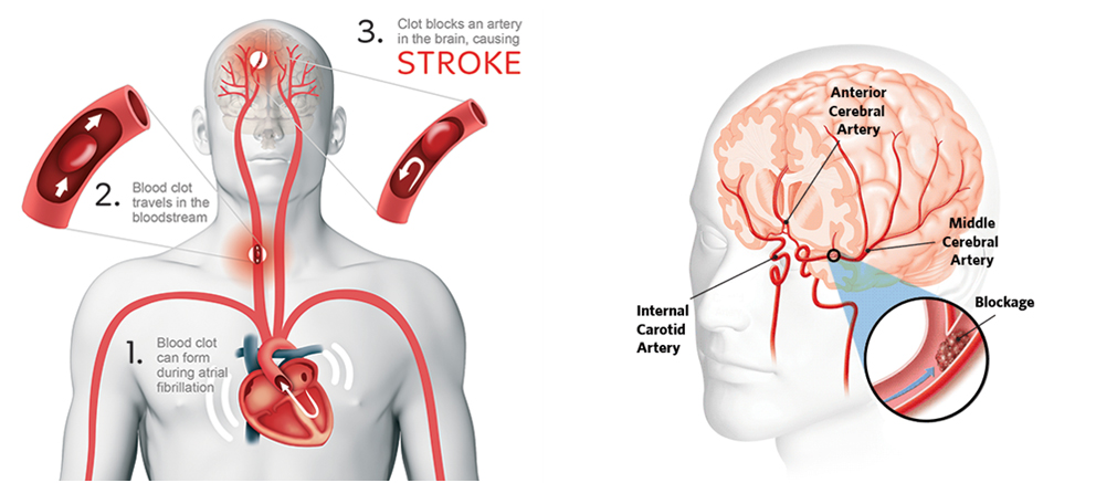 Ischemic Stroke Aspiration Systems Market