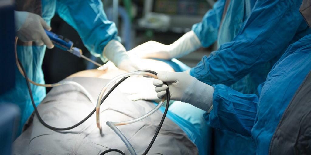 Liposuction Surgery Devices Market