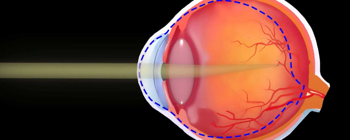 Myopia and Presbyopia Treatment Market