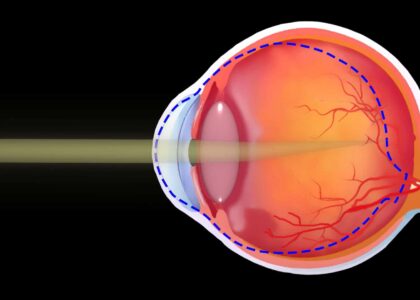 Myopia and Presbyopia Treatment Market