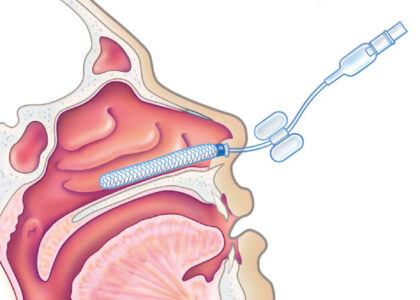 Nasal Packing Devices Market