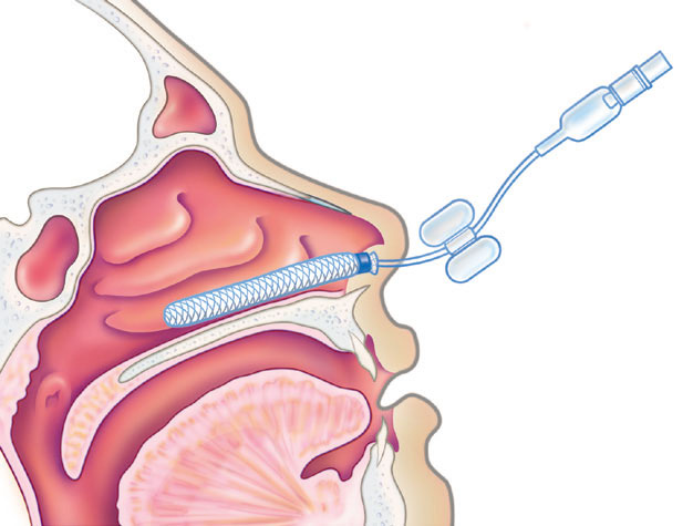 Nasal Packing Devices Market