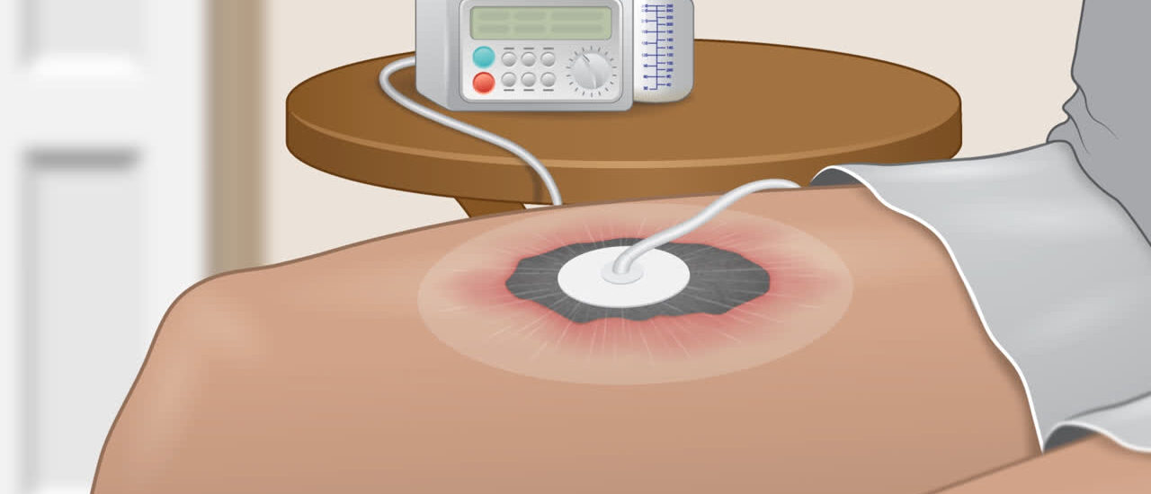 Negative Pressure Wound Therapy Market