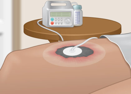 Negative Pressure Wound Therapy Market