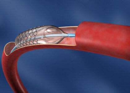 Neurovascular Devices Interventional Neurology Market