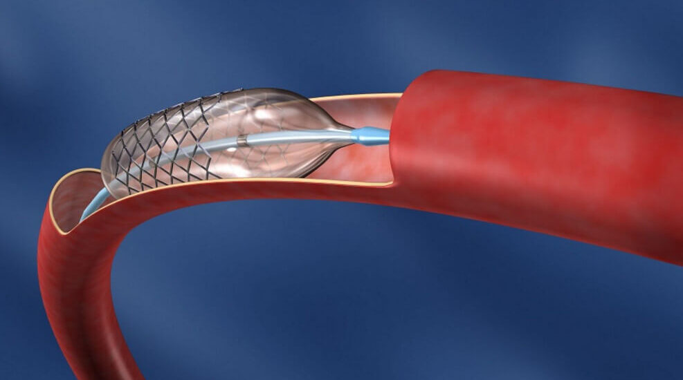 Neurovascular Devices Interventional Neurology Market