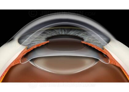 Phakic Intraocular Lenses (IOL) Market