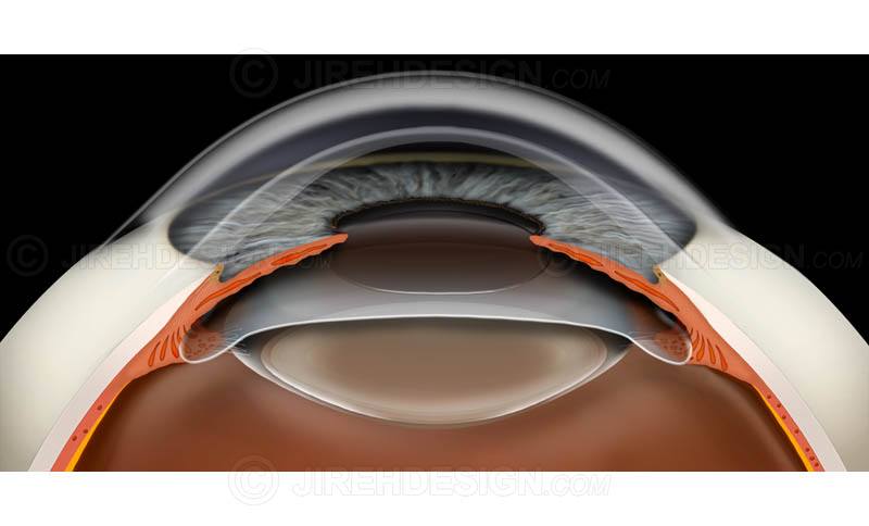 Phakic Intraocular Lenses (IOL) Market