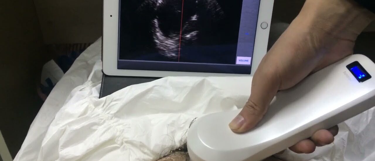 Portable Ultrasound Bladder Scanner Industry