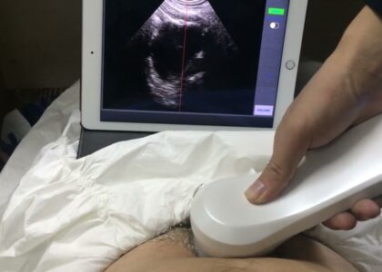 Portable Ultrasound Bladder Scanner Industry