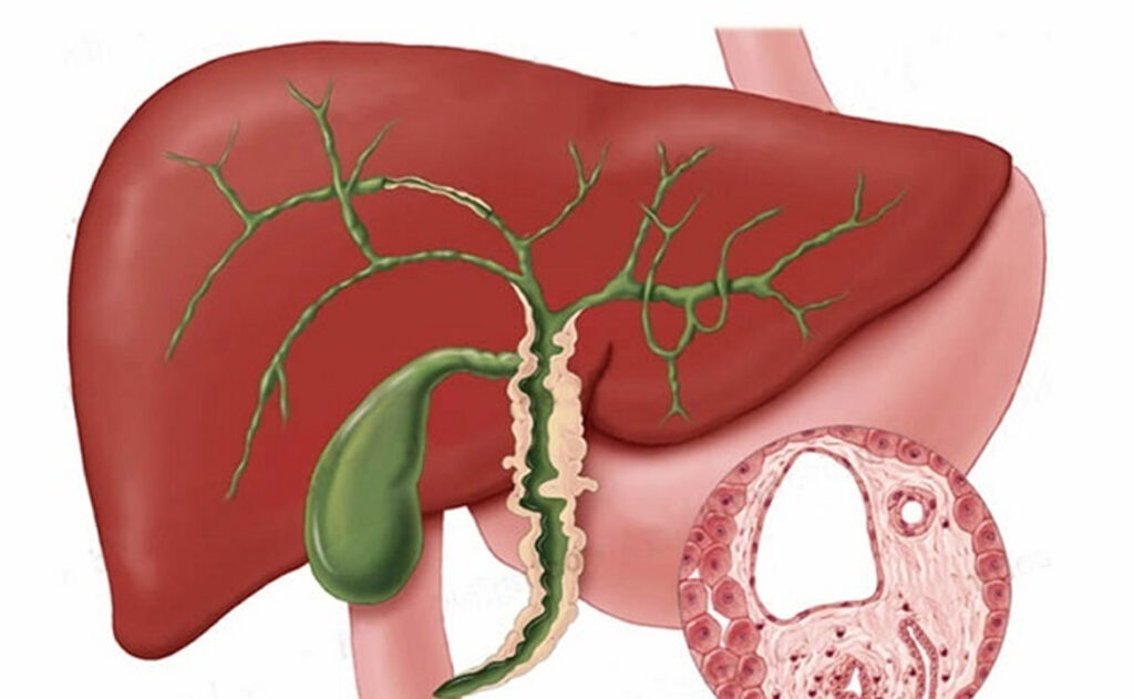 Primary Sclerosing Cholangitis (PSC) Market