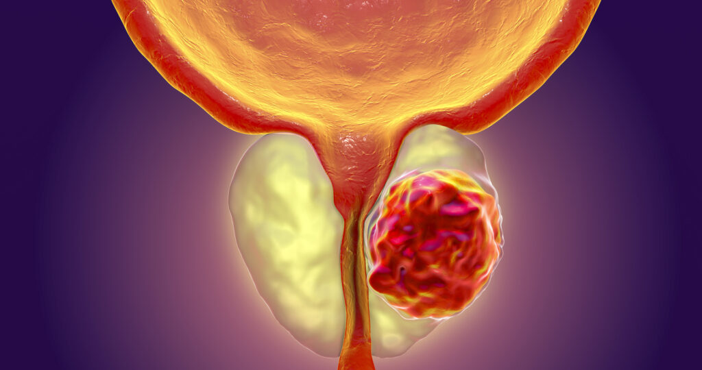 Prostate Cancer Market