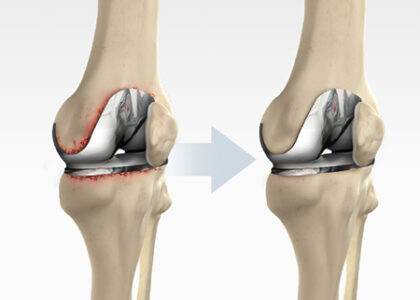 Revision Knee Replacement Industry