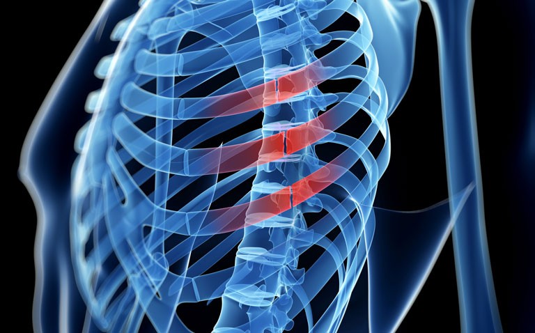 Rib Fracture Repair Systems Market