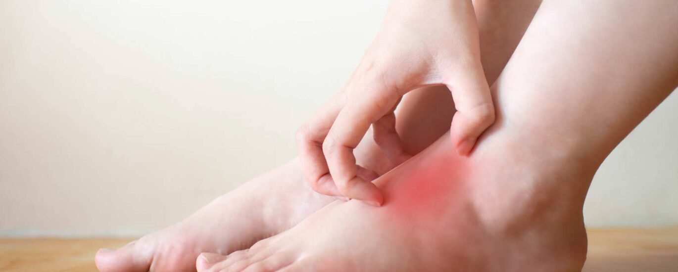 Tinea Pedis Treatment Market