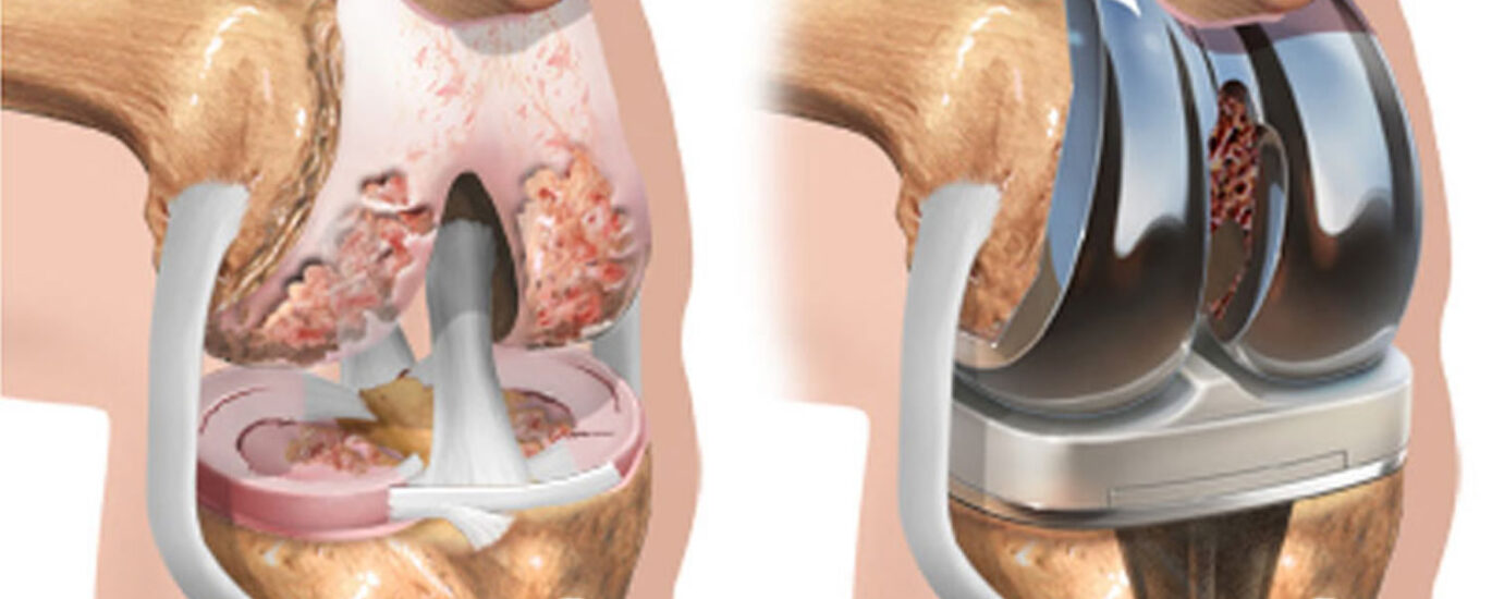 United States Knee Replacement Industry